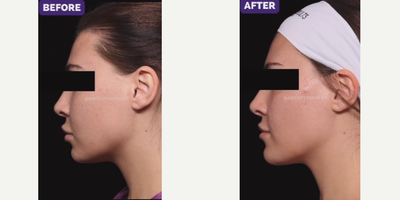 25-34 year old woman treated with Buccal Fat Removal - Buccal fat pad removal is a procedure that permanently reduces the size of your cheeks.The procedure can be done under local numbing with minimal downtime.