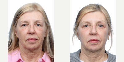 62 year old woman treated with Eyelid Surgery, CO2 Laser - At 62, this female patient was concerned with aging skin and excess fat pads around her eyes. She underwent upper and lower blepharoplasty, achieving a refreshed, more youthful, and well-rested appearance.
