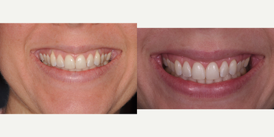 25-34 year old woman treated with Gingival Graft - Cosmetic gum plastic surgery. Recession coverage performed on upper right and left canines (##6,11). In this particular case its a very significant esthetic improvement to otherwise very long looking canines visible with a high smile line of this young lady