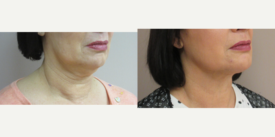 Chin Liposuction, Neck Lift - Patient had a neck lift with liposuction.