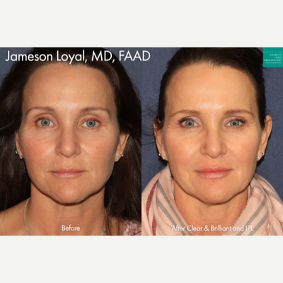 Woman treated with clear and brilliant photofacial - Patient received laser resurfacing to improve the overall tone and texture of her skin.