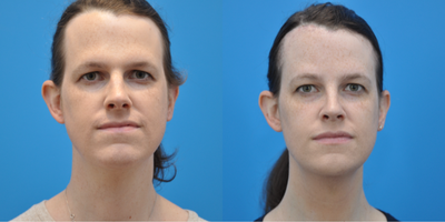 25-34 year old transgender woman treated with Facial Feminization Surgery, Transgender Facial Feminization Surgery, Brow Bone Re - This patient is a transgender female that underwent forehead reduction, brow bone reduction with sinus set back and orbital rim contouring, browlift, rhinoplasty, and shave genioplasty.