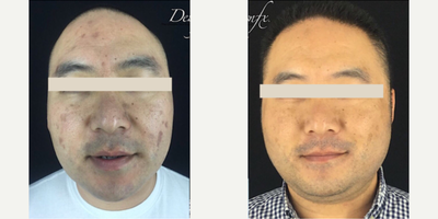 Man treated with Fraxel Laser - Man treated with Fraxel Laser