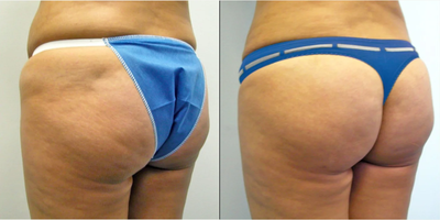 25-34 year old woman treated with Butt Augmentation - Liposuction to the abdomen, back and waistline with fat transfer to the buttock.