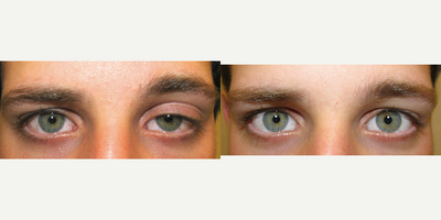 18-24 year old man treated with Ptosis Surgery for left congenital ptosis - External levator resection was utilized to treat this young man's congenital ptosis.