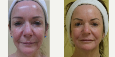 Laser resurfacing with Scion erbium laser - &nbsp;These are her results 3 months after her laser procedure.