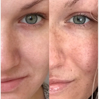 35 Year Women using glycolic acid peels - 35 Year old women using glycolic acid peels.Picture on left is after, Picture on right is before! The series of glycolic peels have helped reduce sunspots and hyper-pigmentation on her cheeks, revealing a clearer skin! Photo was provided by patient via her social media platform.