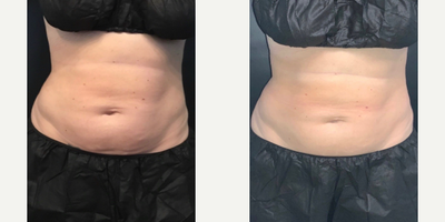 45-54 year old woman treated with truSculpt 3D, truSculpt iD - Custom body contouring using TruSculpt. 1.5 inches down!