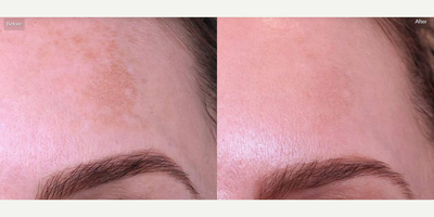 Woman treated with Fraxel Laser - Woman treated with Fraxel Laser