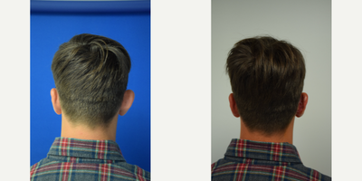 18-24 year old man treated with Ear Surgery, Earfold - Patient with unilateral ear deformity, wanted both ears to look the same. What a great difference and he feels much more confident now!