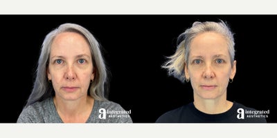 45-54 year old woman treated with IPL - The patient is a 52-year-old female with concerns about dark spots and fine lines. To improve her skin tone and address signs of aging, she received a series of IPL treatments. The results are after two treatments.