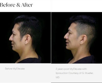 45 year old man treated with MyEllevate - MyEllevate with liposuction.