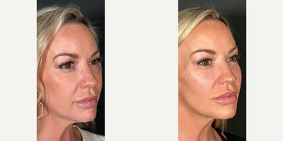 35-44 year old woman treated with Voluma - Non surgical cheek augmentation using Juvederm Voluma.