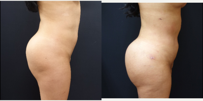 25-34 year old woman treated with Brazilian Butt Lift Revision - The patient had a previous Brazilian Butt Lift done several years ago and now presents for further augmentation. While she had some improvement in her shape and buttock she did not reach her aesthetic goals. I revised her buttock augmentation with a second round of fat transfer. She had liposculpting of the abdomen, inner thighs, back and flanks. This fat was then processed and used to augment her buttock. Her second Brazilian Butt Lift consisted of 1100cc of fat being transferred per side for her augmentation.&nbsp;