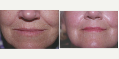 55-64 year old woman treated with Fractora RF - 55-64 year old woman treated with Fractora RF