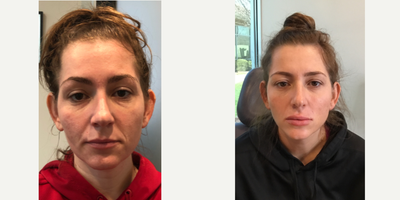 25-34 year old woman treated with Liquid Facelift - Our patient here has received filler and Botox over a period of time to achieve a refreshed appearance. Filler to the under eyes, smile lines and lips along with Botox. All done by Cynthia Sanchez, RN BSN