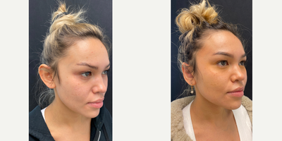 18-24 year old woman treated with Ear Surgery - 18-24 year old woman treated with Ear Surgery