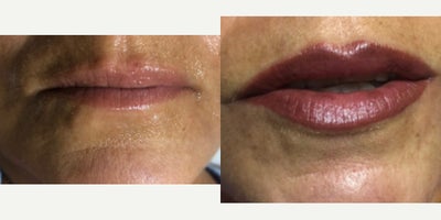 35-44 year old woman treated with Permanent Makeup - Permanent Makeup Lip ShadingEnhance your lip color with our expertly applied permanent makeup lip shading service.