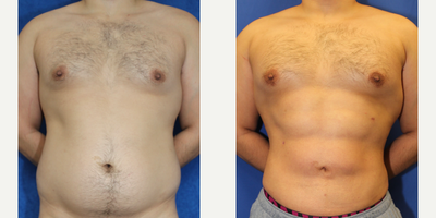 25-34 year old man treated with Vaser Liposuction - This 27-year-old white male patient achieved his desired results after undergoing VASER Hi-DEF Lipo of the abdomen and superior iliac crest procedure with Dr. J. Timothy Katzen in Beverly Hills, CA. Standing at 5'9 and weighing 195 pounds, the patient sought a more defined and sculpted abdomen.The VASER Hi-DEF Lipo technique utilized during the procedure allowed for precise targeting and removal of excess fat in the abdominal area, resulting in a sculpted 6-pack abdomen. Dr. J. Timothy Katzen's expertise and advanced techniques played a crucial role in achieving the patient's desired outcome.It's wonderful to hear that the patient is very happy with the results of the procedure. A sculpted abdomen can greatly enhance one's confidence and provide a more defined aesthetic appearance. If you have any more questions or need further information, feel free to ask!