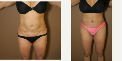 35-44 year old woman treated with Tummy Tuck Revision - revision of tummy tuck after another surgeon