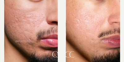 Acne Scars Combination Treatment with TCA Cross + Subcision + CO2 Laser + Fillers - This patient did TCA Cross + Deep Subcision + Ablative and Fract. CO2 Laser + LA Sculptra for his acne scars.