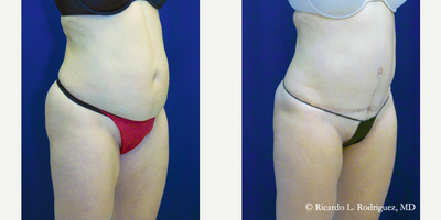 Woman treated with Tummy Tuck, Liposuction - Woman treated with Tummy Tuck, Liposuction