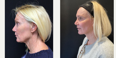 55-64 year old woman treated with QuickLift - Quicklift with neck lipo, suture platysmaplasty, fat transfer to face
