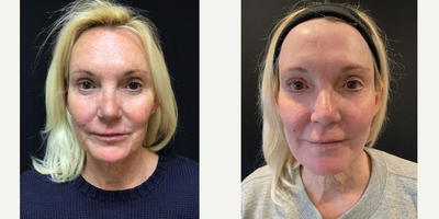 55-64 year old woman treated with QuickLift - Quicklift with neck lipo, suture platysmaplasty, fat transfer to face
