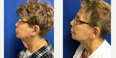 75 and up year old woman treated with QuickLift - Quicklift, platysmaplasty