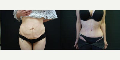 25-34 year old woman treated with Drainless Tummy Tuck - 25-34 year old woman treated with Drainless Tummy Tuck