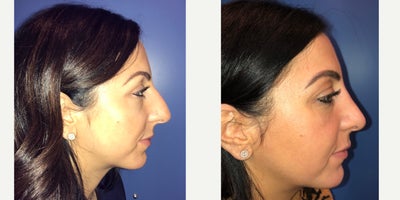25-34 year old woman treated with Rhinoplasty - Patient is 8 months post op Rhinoplasty