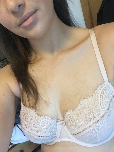 From 34J to 34D - Finally Got my Dream Breasts! - Review - RealSelf