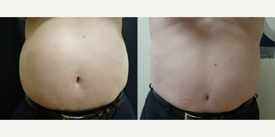 55-64 year old man treated with Vanquish - Series of 5 treatments