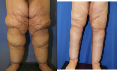 Calf Reduction 1 - This is a 47 year old female who weighed 443 lbs. &nbsp;She had gastric bypass surgery and lost 230 lbs. &nbsp;After weight loss, she was not happy with her inner thighs. &nbsp;She underwent a spiral medial thigh lift/reduction and calf reduction.