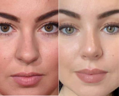 My Rhinoplasty Experience With Dr Mirza Firat Istanbul Review