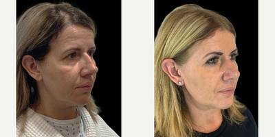 45-54 year old woman treated with Rhinoplasty - A patient on whom a hybrid ultrasonic and preservation rhinoplasty has been performed.  She has a high dorsal hump and all bone work has been acrried out using piezo-surgery ( ultrasonic) to reshap the bone. The sof tissue and cartilage reshaping is performed using preservation techniques where the cartilage is not removed but is reshaped and re-configured in position which maintains long term structural integrity.From the front view a bulbous tip has been refined and a curvature in the nasal bridge has been straightened.