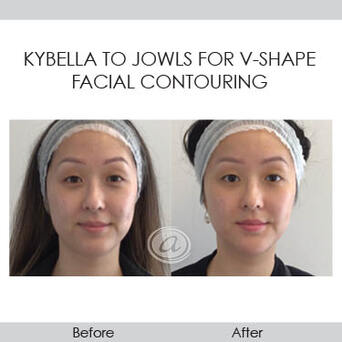 Kybella before and after photo