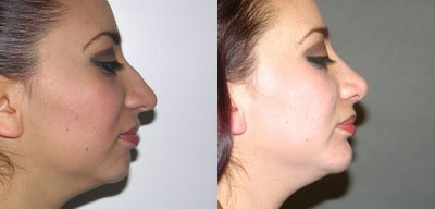 Rhinoplasty before and after photo