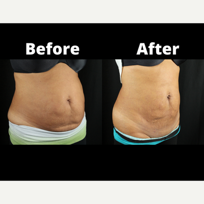 BodyTite before and after photo