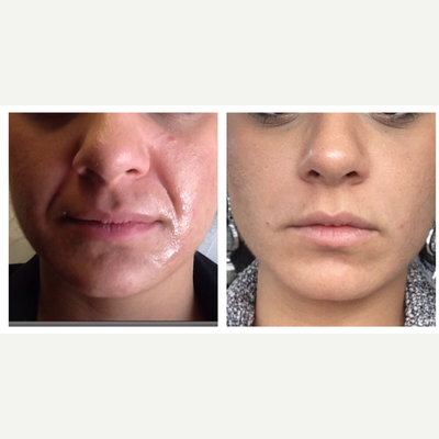 Cheek Fillers before and after photo