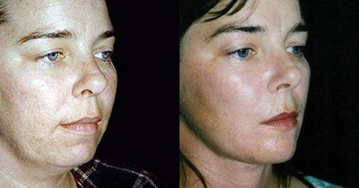 Facelift before and after photo