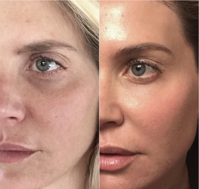 Botox before and after photo
