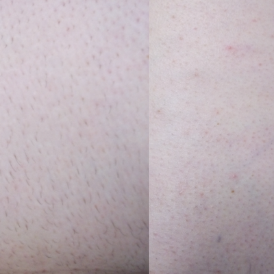 Laser Hair Removal before and after photo