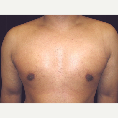 Macromastia (large breasts) Cause Multiple Problems - Miguel Delgado, MD