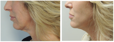 Facelift before and after photo
