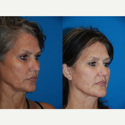 Facelift before and after photo