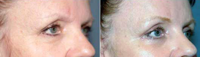 Eyelid Surgery before and after photo