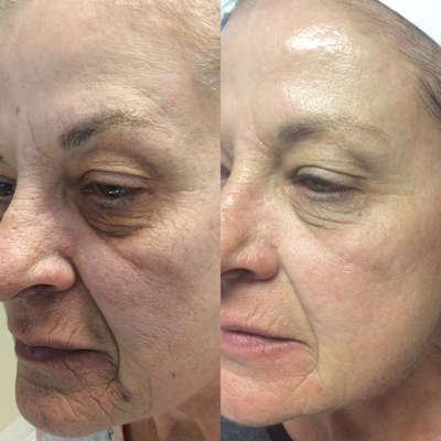Microneedling before and after photo