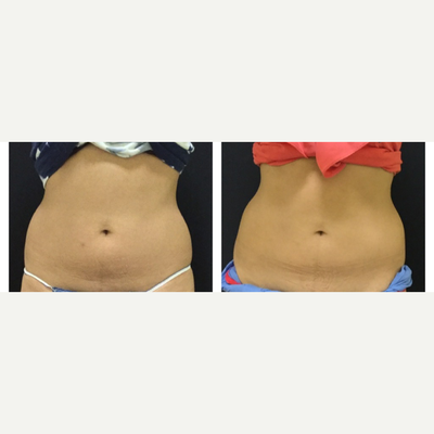 CoolSculpting before and after photo