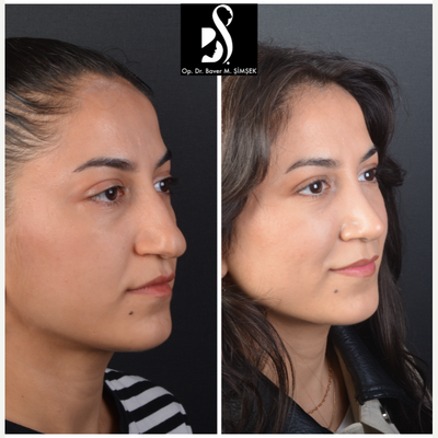 Rhinoplasty before and after photo